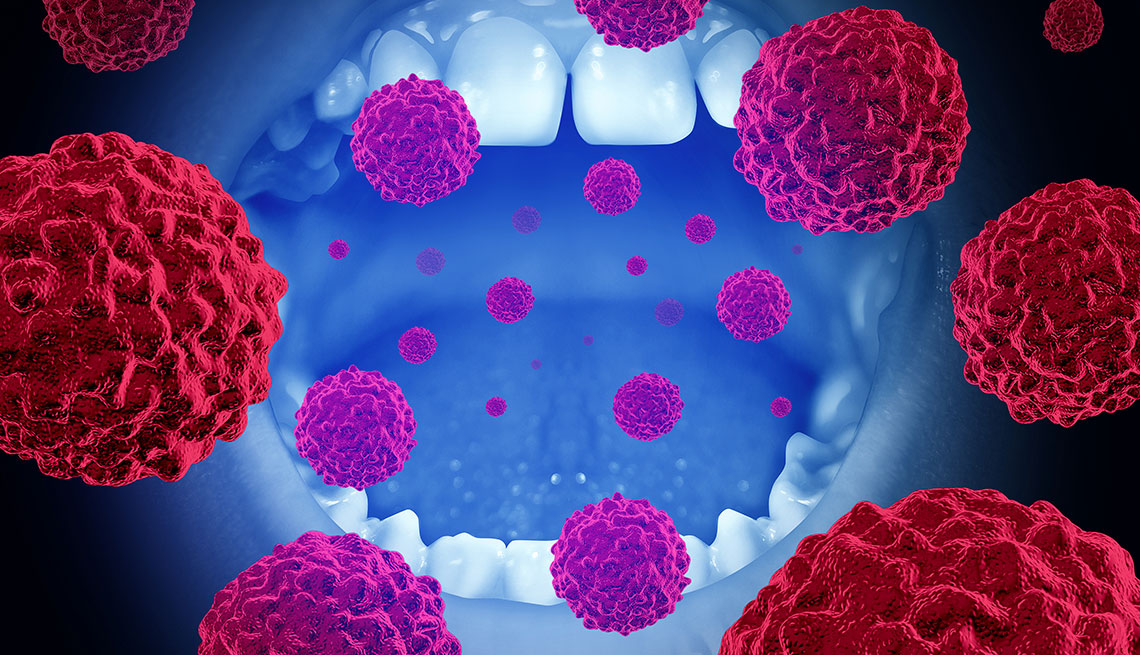 Gráfico sobre el cáncer oral